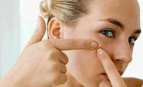 [health] ব্রণ (Pimples)  থেকে মুক্ত থাকার কিছু প্রয়োজনীয় টিপস…