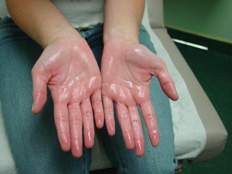 হাত ঘামা রোগ ভালো করার ৬ টি উপায় । হাইপারহাইড্রোসিস । 6 Ways To Cure Hand Sweating Disease