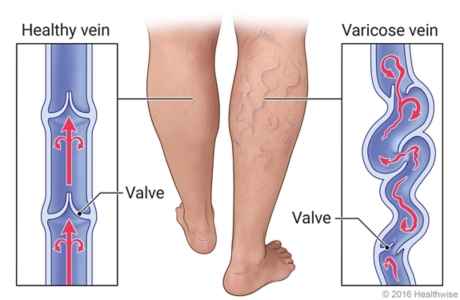 Vascular varicoseza, Ce cauzează vene varicoase